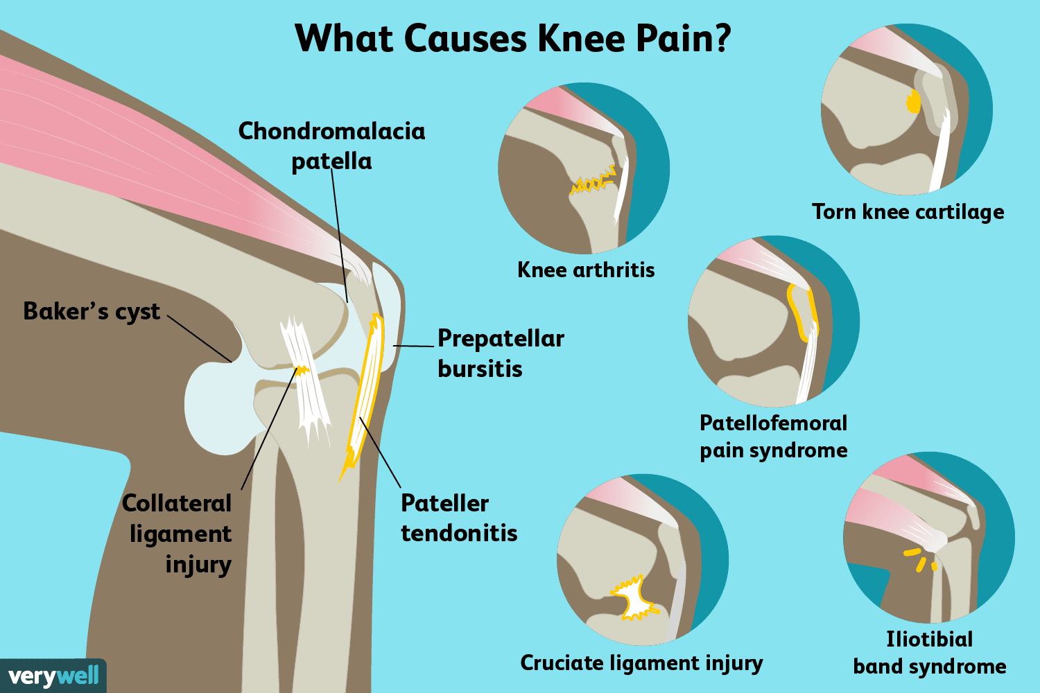 knee pain